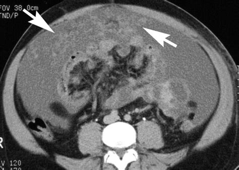 Primary Peritoneal Cancer Symptoms