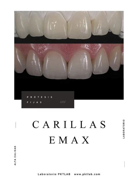 Carillas EMAX PKTLAB Laboratorio Dental