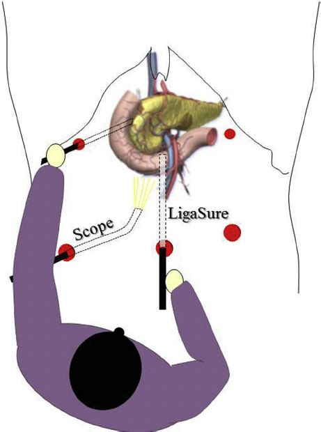 Findings During Dissection Between The Pancreas And The Mesenteric Download Scientific Diagram