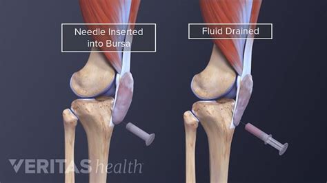 Prepatellar Bursitis Treatment