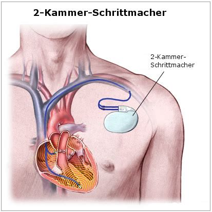 Schrittmacherimplantation Kardiotechnik in Österreich