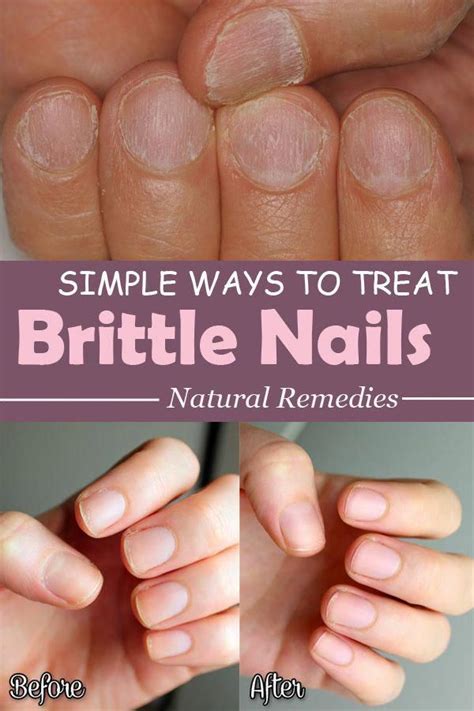 Brittle Nails Are A Problem For You Not Anymore With These Simple