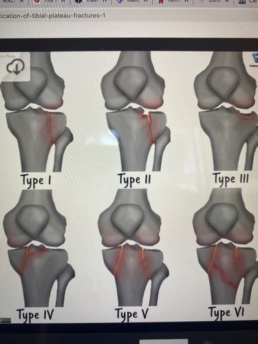 Knee Flashcards Quizlet