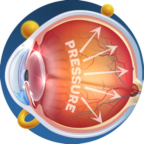 Treatment Of Glaucoma