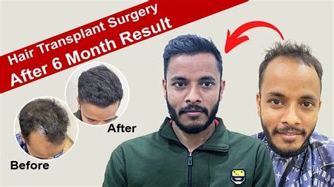 Hair Transplant Result Month Fue Hair Transplant In Ranchi Hair