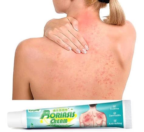 Pomada Psor Ase Eczema Dermatite Coceira Alergia Pru Do Parcelamento