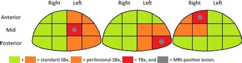 An Magnetic Resonance Imaging Directed Targeted Plus Perilesional Biopsy Approach For Prostate