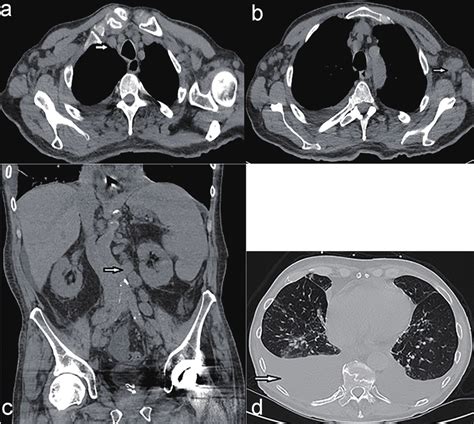 A Ct Scan Of The Chest Showing Mediastinal Lymphadenopathy Arrow Download Scientific