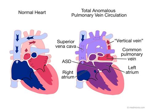 Pin on Anomalous Pulmonary Venous Return (T-APVR & P-APVR)