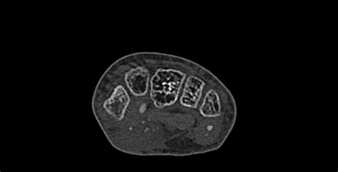 Calcifying Aponeurotic Fibroma Image Radiopaedia Org