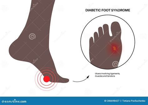 Diabetic Foot Ulcers Cartoon Vector 286698427