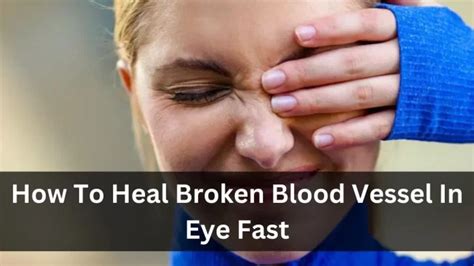 How To Heal Broken Blood Vessel In Eye Fast Inowixer