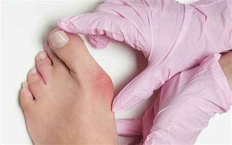 Schiefstellung Vom Gro En Zeh Hilfe Bei Hallux Valgus