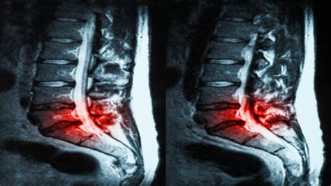 Mri For Herniated Disc How To Interpret And Its Available Treatments