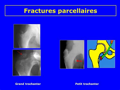 Fractures Du Col Ppt T L Charger