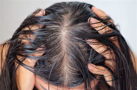 Ways To Deal With An Oily Scalp Ziering Medical