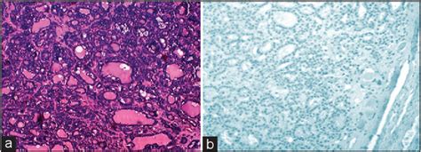 Figure 1 From DIAGNOSTIC ROLE OF GALECTIN 3 EXPRESSION IN BENIGN