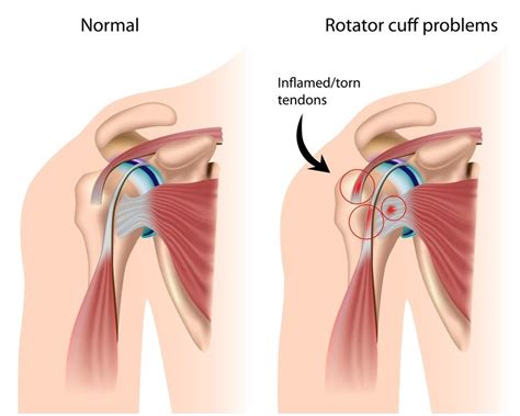 Rotator Cuff Injury Guide Causes Symptoms And Treatment Options