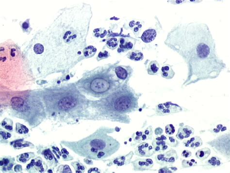 Chlamydia Trachomatis Gram Stain Morphology