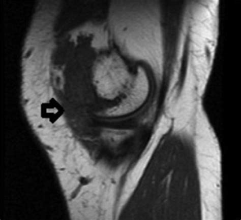 Synovial Hemangioma In The Knee Mri Findings Abstract Europe Pmc