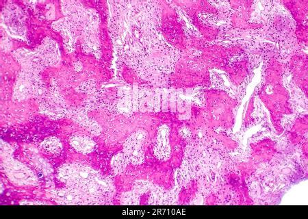 Histology of callus, a thickened skin made as a result of pressure, repeated friction, light ...