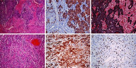 Photomicrographs Of Gliosarcoma With Angiosarcomatous Component A