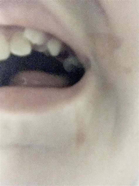 What Could These Marks Be On My Daughter S Teeth 7 Years Old With Oi Type 1 All 11 Adult