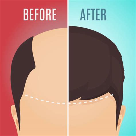 Receding Hairline Background Illustrations Royalty Free Vector