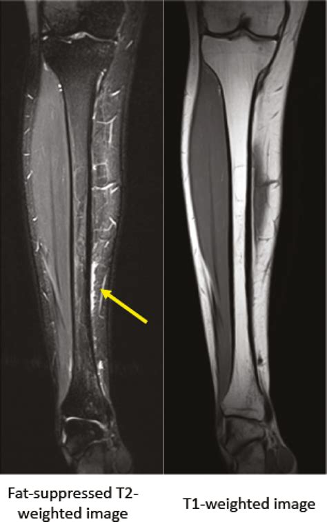 View Of Evaluation And Diagnosis Of Tibial Bone Stress Injuries In