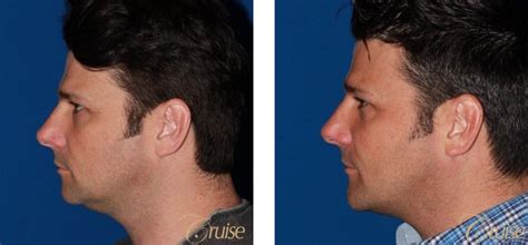 Male Chin Implant Before And After