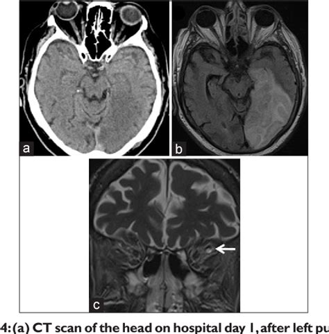 Figure From Third Nerve Palsy Following Carotid Artery Dissection And