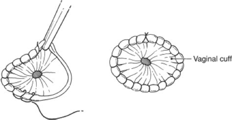 Pediatric Exploratory Laparotomy For Trauma Malrotation Or