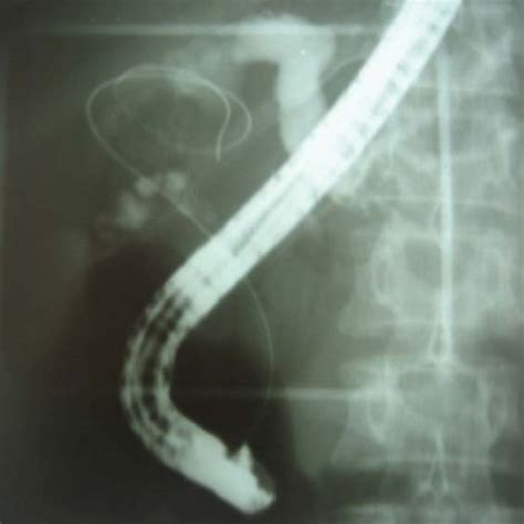 Ercp Showed Dilation Of Intrahepatic Bile Ducts Download Scientific Diagram