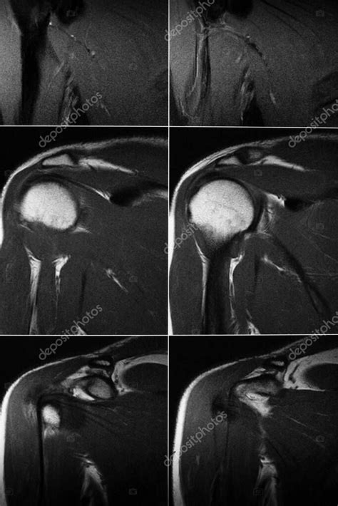 Resonancia Magn Tica De La Articulaci N Del Hombro