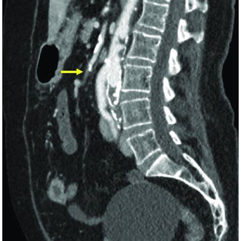 Sagittal Computed Tomography Angiography Cta Image Showing Superior