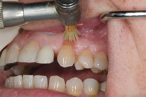 Tooth Abfraction Treatment