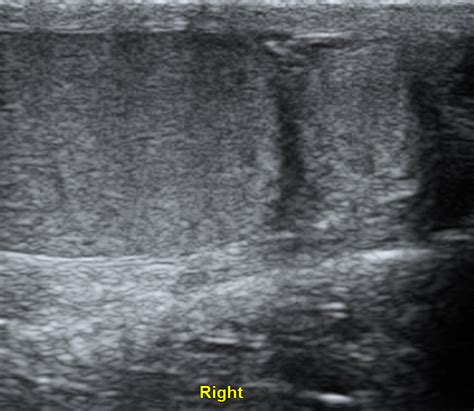 Extratesticular Adenomatoid Tumor Image