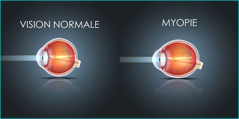 myopie correction laser Ophtalmologie Hyères Var 83