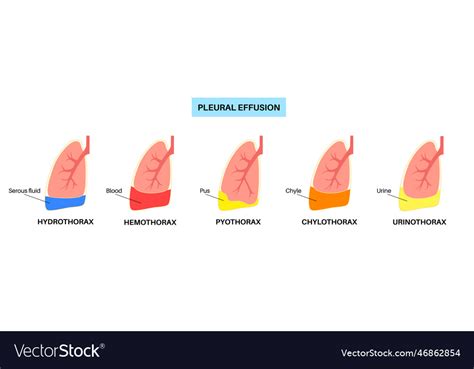 Pleural Effusion Poster Royalty Free Vector Image