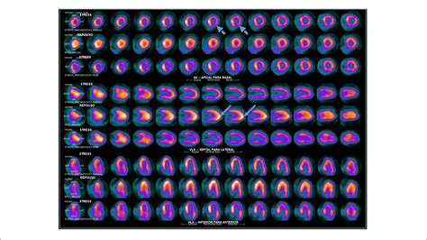 Avalia O De Reserva De Fluxo Coronariano Pela Cintilografia Mioc Rdica