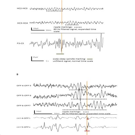 Schematic Illustration Of Thalamic Sleep Spindles And Hippocampal