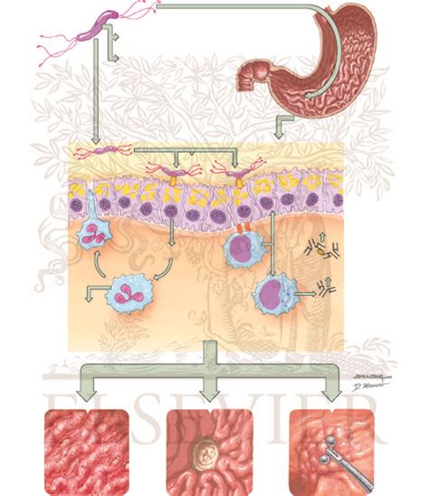 Helicobacter Pylori Infection Etiology And Pathogenesis Of