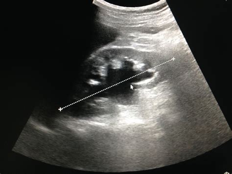 VIETNAMESE MEDIC ULTRASOUND CASE 458 PERIAORTIC LYMPHOMA Dr PHAN