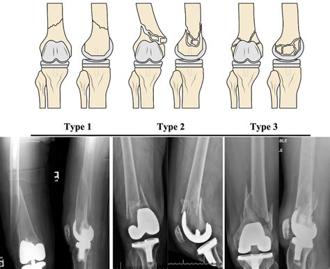 Pictorial And Radiographic Depictions Of Proposed Distal Femoral Download Scientific Diagram