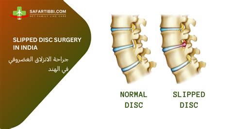 Slipped Disc Surgery Cost in India: Best Spine Surgeon - Safartibbi