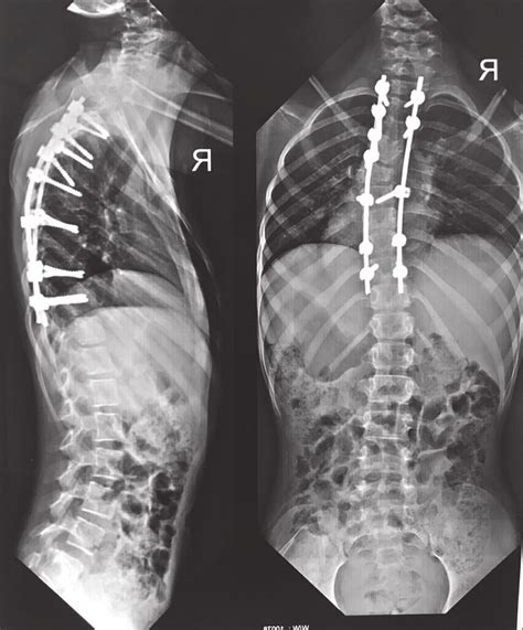 Postoperative Radiographs At Follow Up Showed Correction In Both