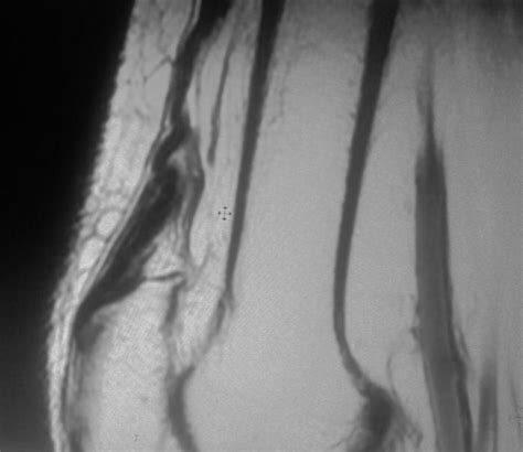 Quadriceps Tendon Tear-MRI - Sumer's Radiology Blog