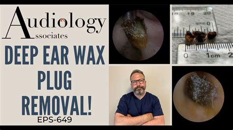 DEEP EAR WAX PLUG REMOVAL EP649 YouTube