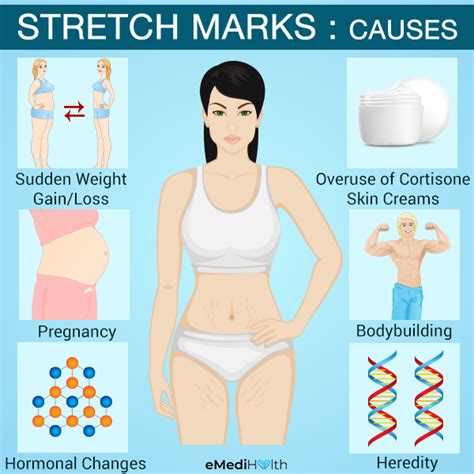 will growth stretch marks go away