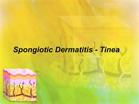 Spongiotic dermatitis tinea | PPT